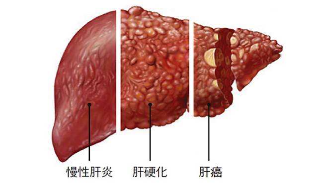 肝硬化营养不良的管理：「五做五不做」 | 一文总结