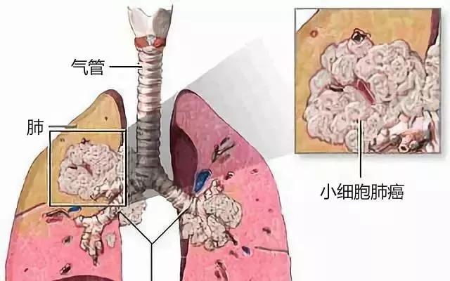 【新资讯】英飞凡Imfinzi免疫治疗药物，小细胞肺癌SCLC患者...