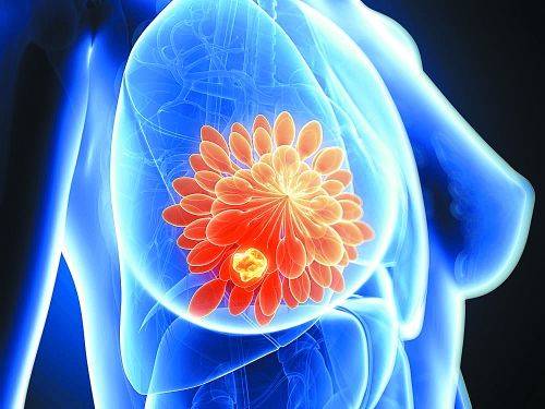 Her-2阳性乳腺癌靶向药大盘点(曲妥珠单抗、拉帕替尼、帕妥珠单抗)疗效对比